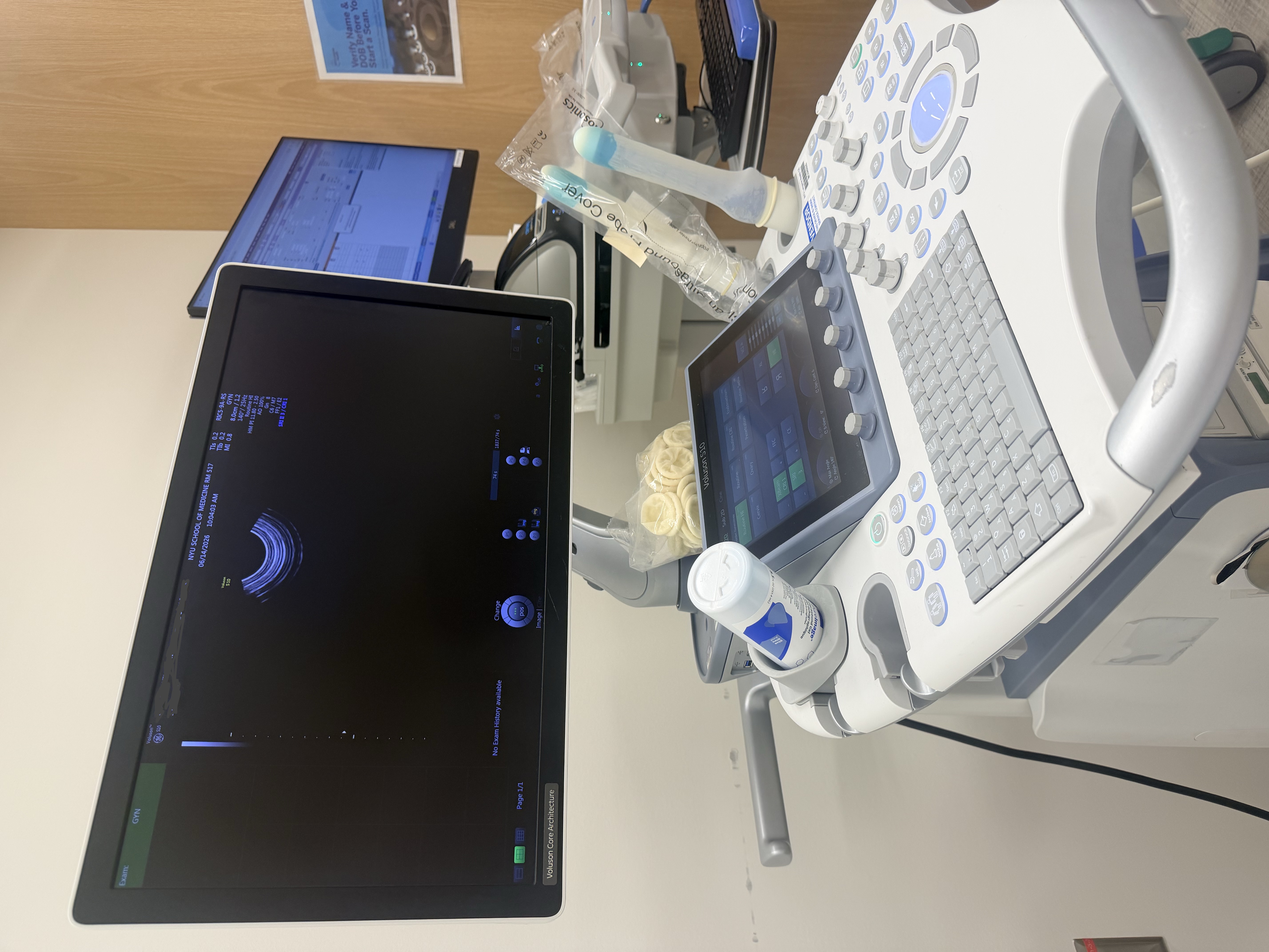 Ultrasound machine screen showing follicle scan
