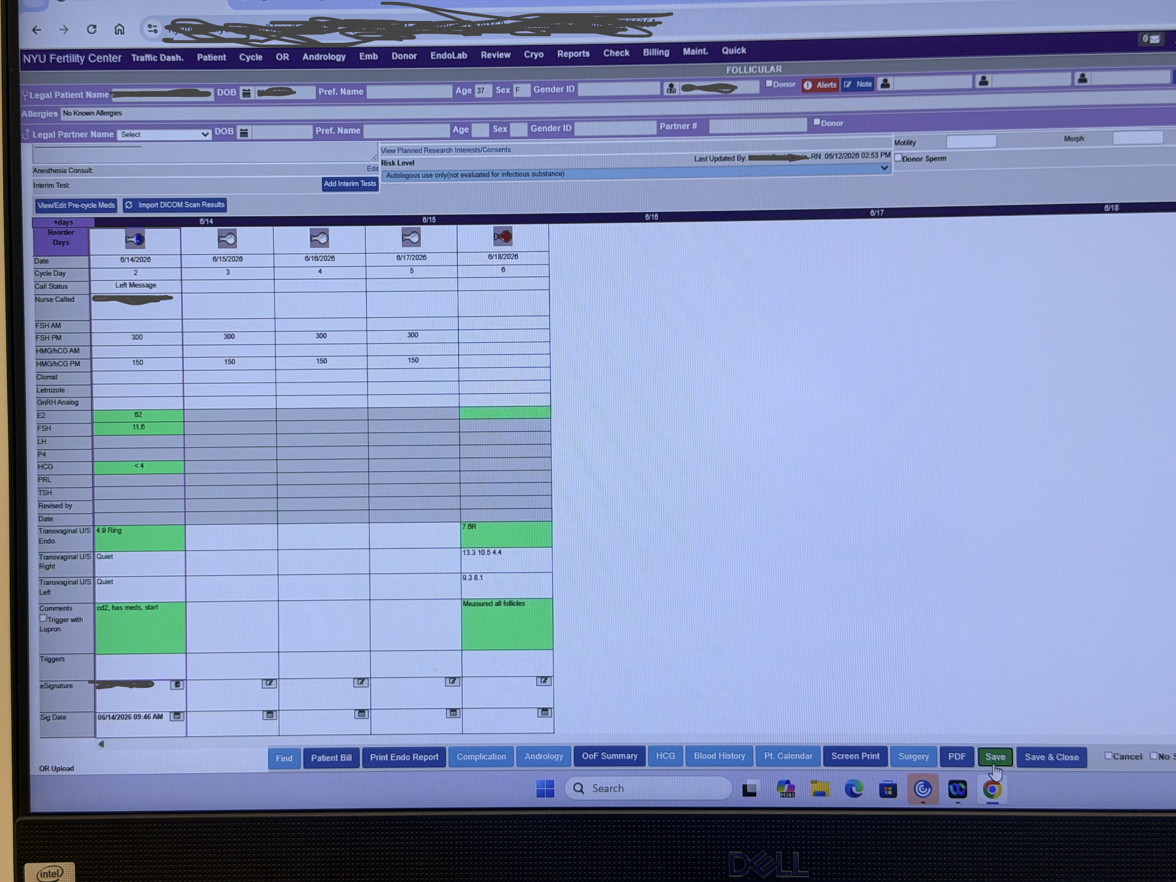 A monitoring chart showing daily medication doses, bloodwork, and follicle measurements from Day 2 through Day 5 of stimulation, with the record's identifying fields blacked out.